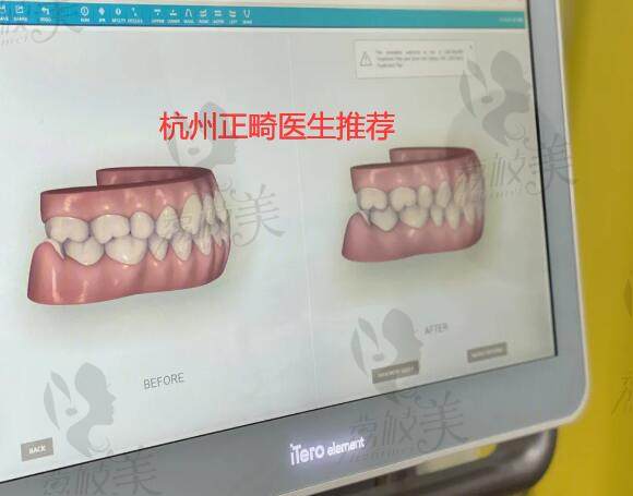 杭州比较有名的正畸医院汇总