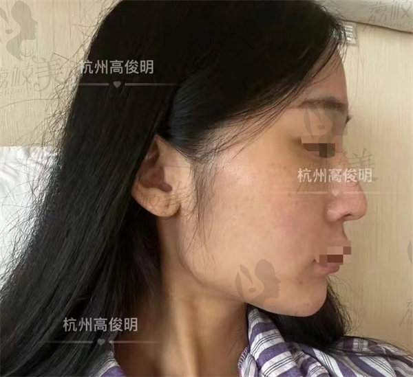 杭州高俊明轮廓案 例