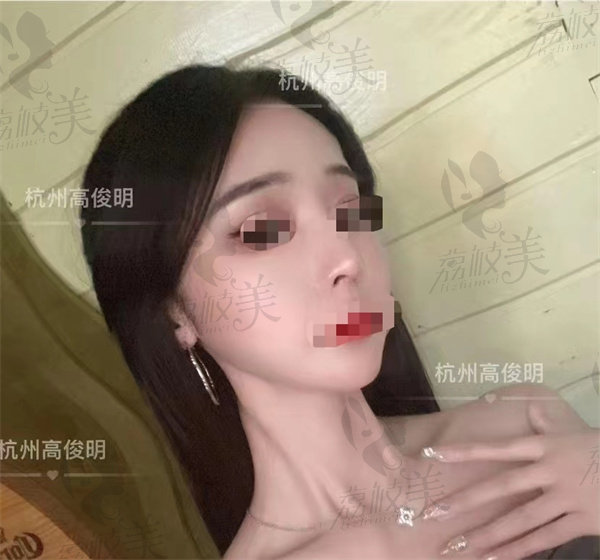 杭州高俊明轮廓案 例