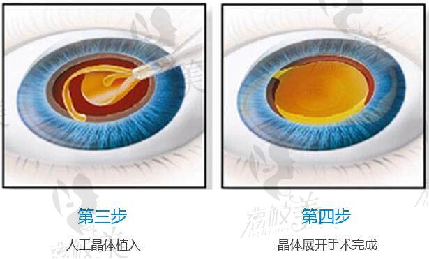 超声乳化白内障手术步骤
