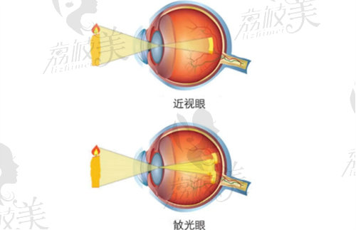 晶体植入手术散光多少度需要定制