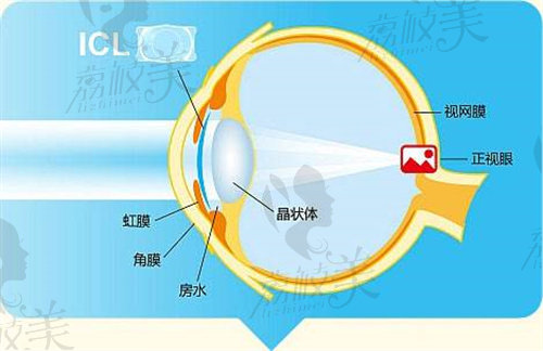 晶体植入50度散光可以不加散光吗