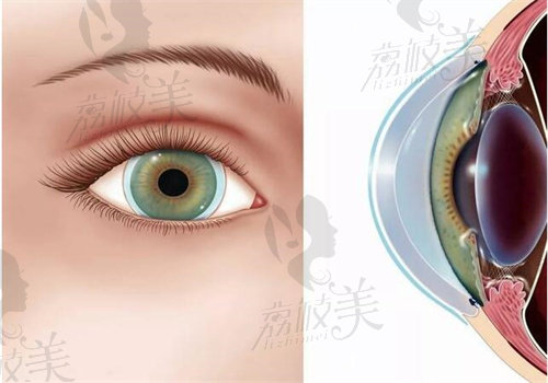 爱尔眼科医院做圆锥角膜交联术操作成熟优势多