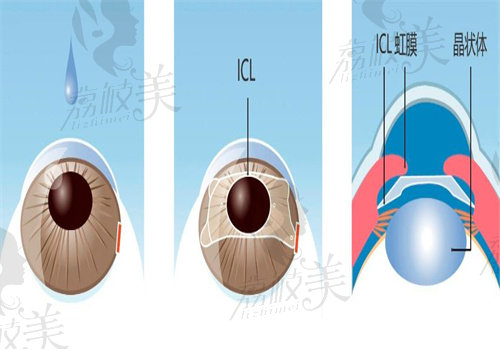 prl晶体植入与icl的区别之材质不同