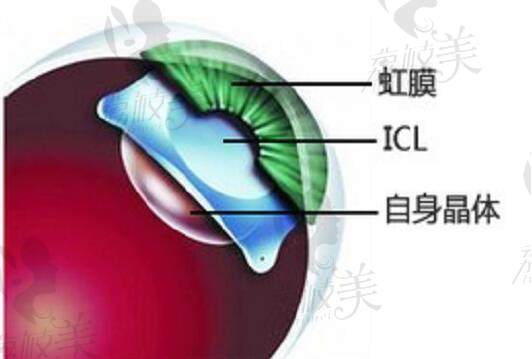 ICL人工晶体植入手术演示