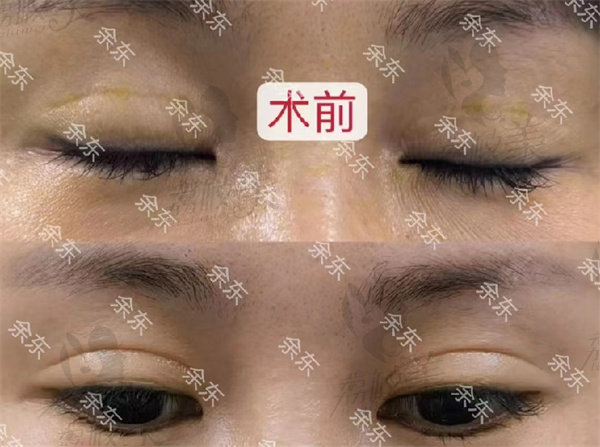 上海时光余东修复双眼皮