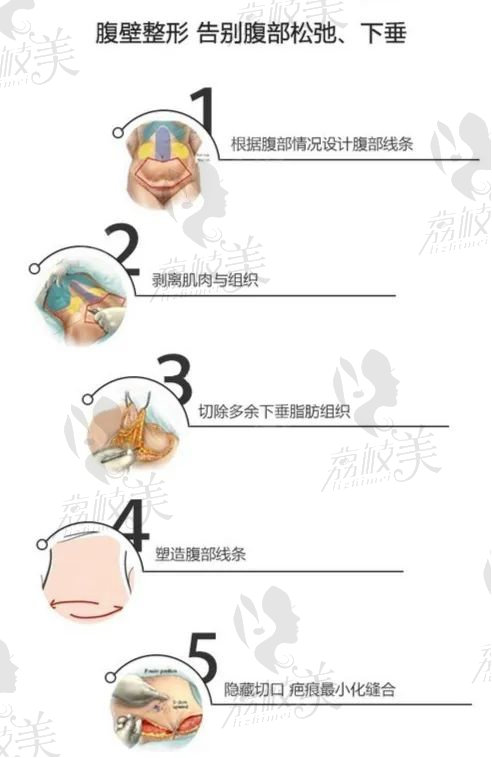 成都现代整形李献和腹壁整形亲身经历分享