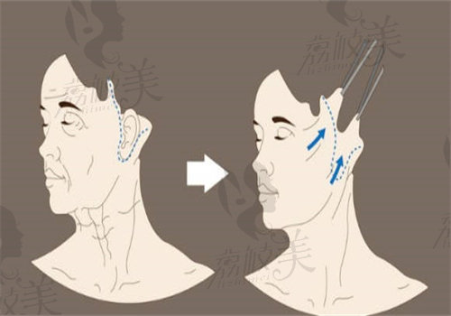 黄寺杜太超小切口拉皮技术是真的牛