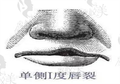 唇裂是什么原因造成的