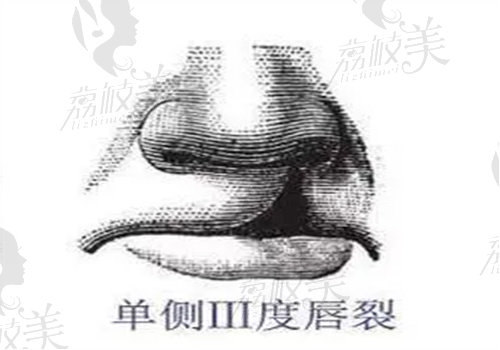 唇裂是什么原因造成的