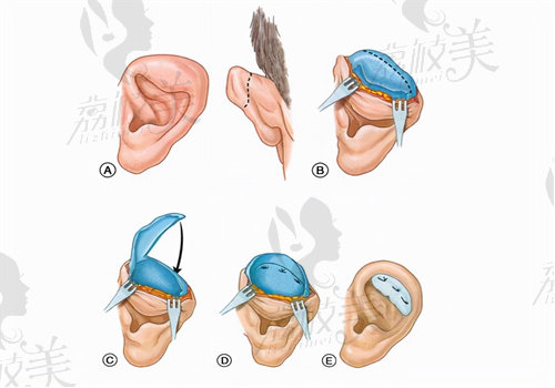 郭树忠教 授做小耳畸形做完耳朵轮廓清晰自然对称
