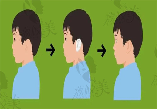 郭树忠教 授做小耳畸形做完耳朵轮廓清晰自然对称.jpg