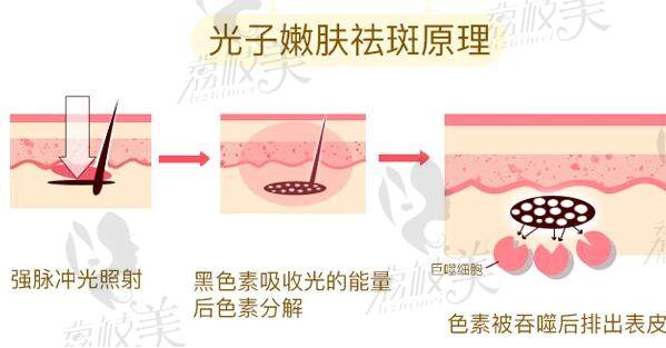 白瓷娃娃和光子嫩肤哪个好