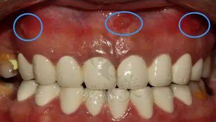 根管治疗中出现瘘管怎么办?牙龈瘘管医生建议不治疗?