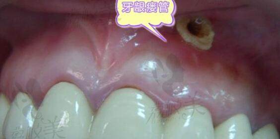 牙龈瘘管医生建议不治疗是不是真的?