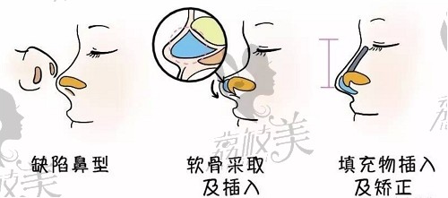 北京鼻修复医生排名