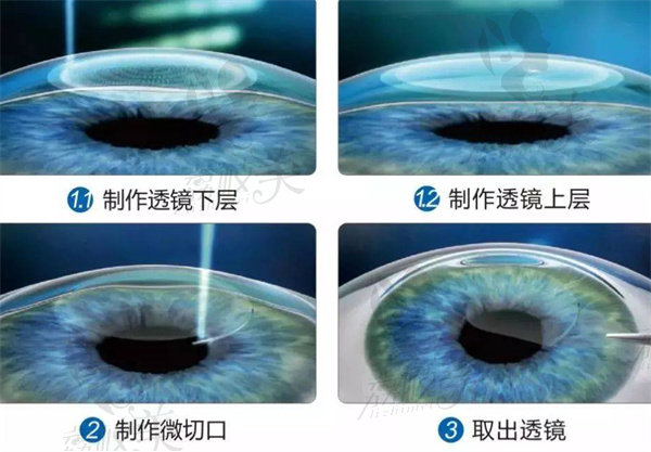 近视可从800度降到100度吗