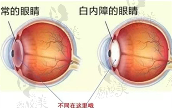 武汉悦瞳眼科门诊部远视手术技术