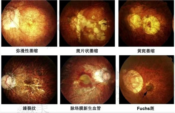 玻璃体腔穿刺术联合糖皮质激素