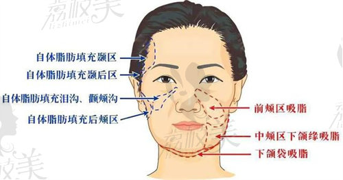 颊脂垫去除后脸部会凹陷吗？不会