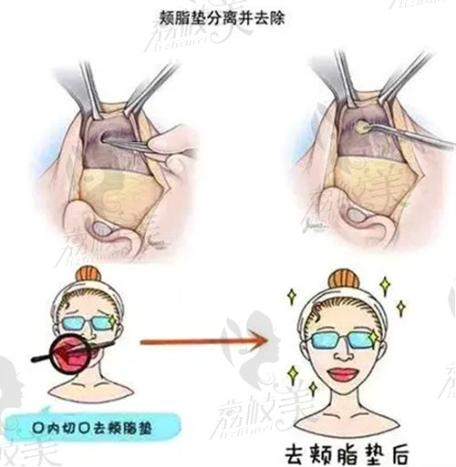 去颊脂垫会老的快吗