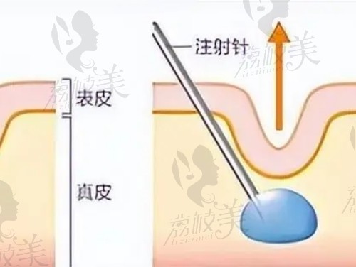 普利果冻针介绍