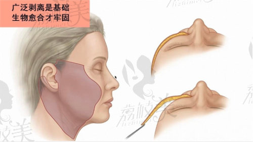 微创小拉皮可以做哪些部位