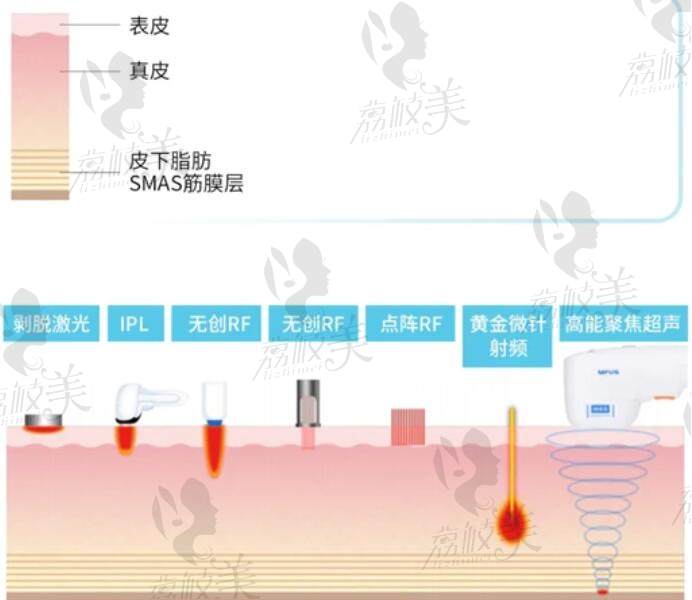 钻石超塑和超声炮哪个好