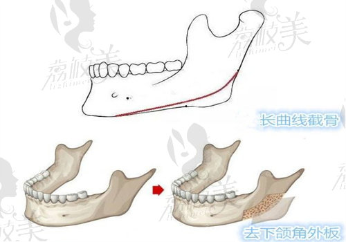 下颌角和长曲线下颌角的区别