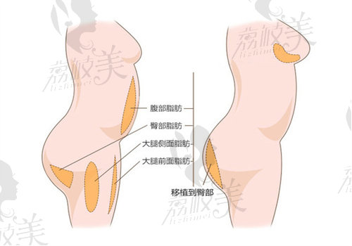 王明利医生做脂肪填充好吗