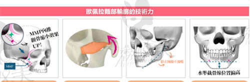 韩国欧佩拉整形轮廓技术好