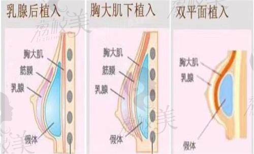 唐毅医生做的隆胸手术很成功