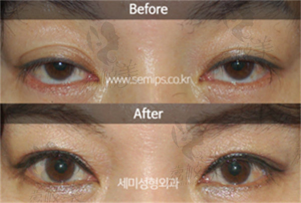 韩国世美双眼皮修复案 例