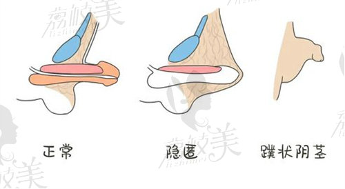 南阳天伦医院男性增粗