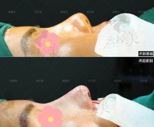 北京宫风勇做鼻整形，双耳鼻综合+筋膜术后即刻