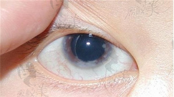原发性开角型青光眼和继发性开角型青光眼