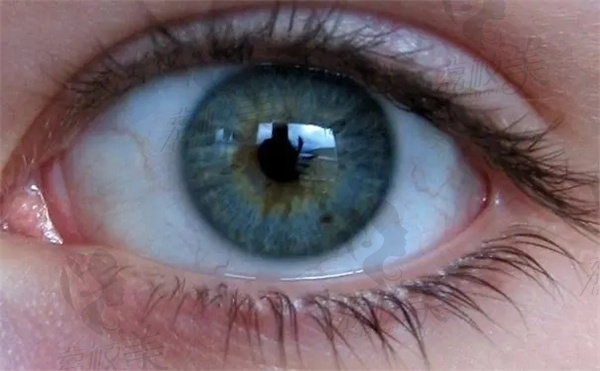 什么是原发性开角型青光眼