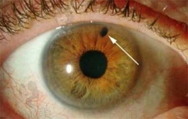 原发性开角型青光眼的症状