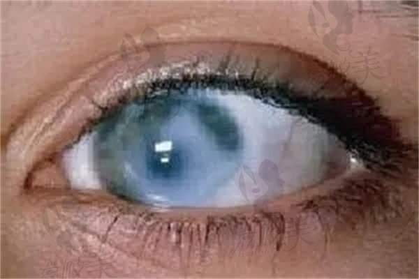 原发性开角型青光眼和继发性开角型青光眼的眼部表现