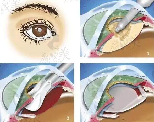 北京晶体植入近视眼手术价格多少钱