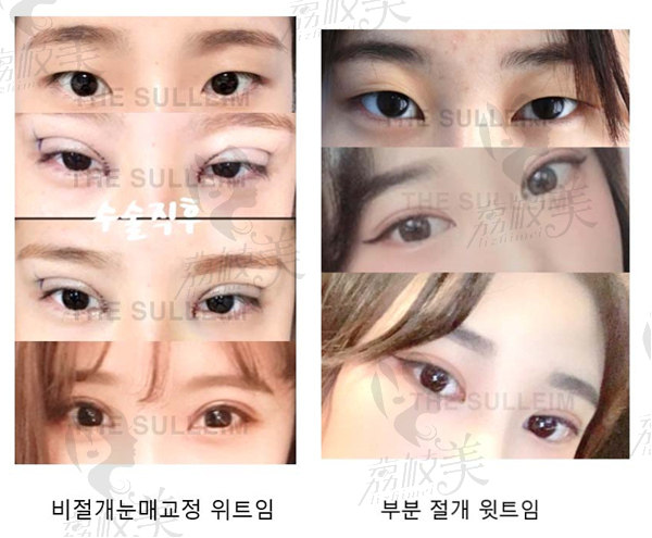 韩国心动整形双眼皮手术图片