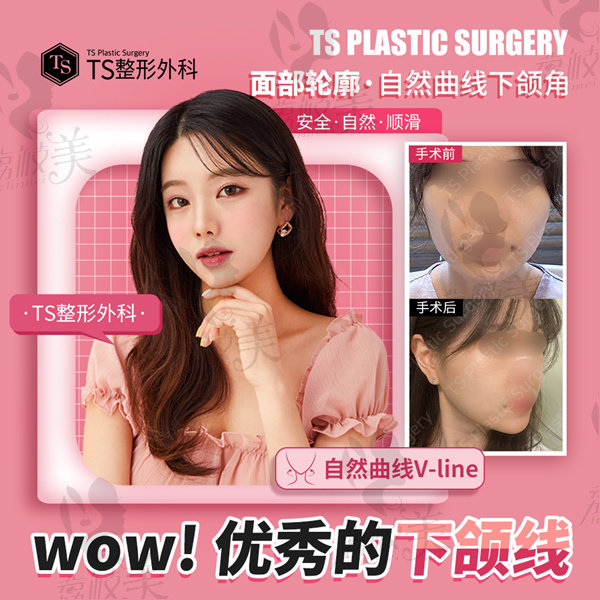 韩国ts整形自然曲线v-line下颌角手术