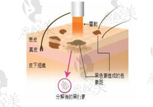 晶体植入和飞秒手术的优缺点