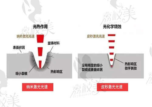 晶体植入和飞秒手术的优缺点