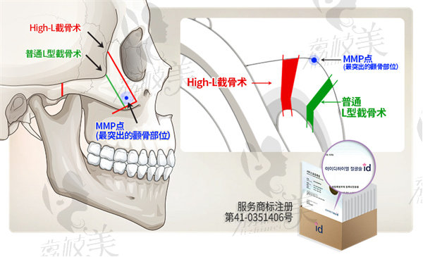 韩国id整形轮廓怎么样