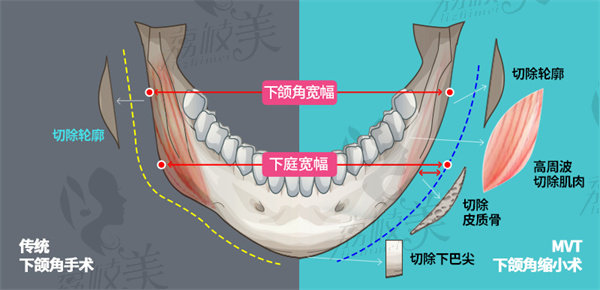 韩国id整形轮廓怎么样