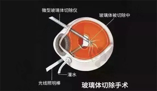 角膜太薄的風險與預防