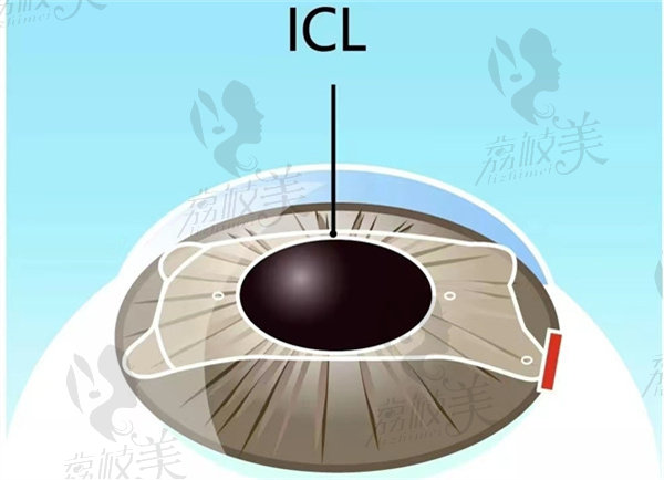 ICL晶体植入