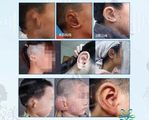 广州高尚余文林耳朵再造收费标准