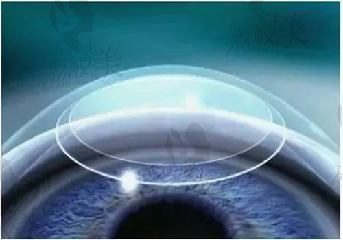 smart激光手术对角膜厚度有要求